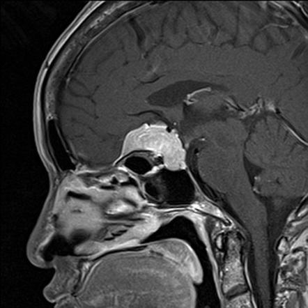 Meningioma