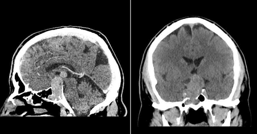 Skull base tumour