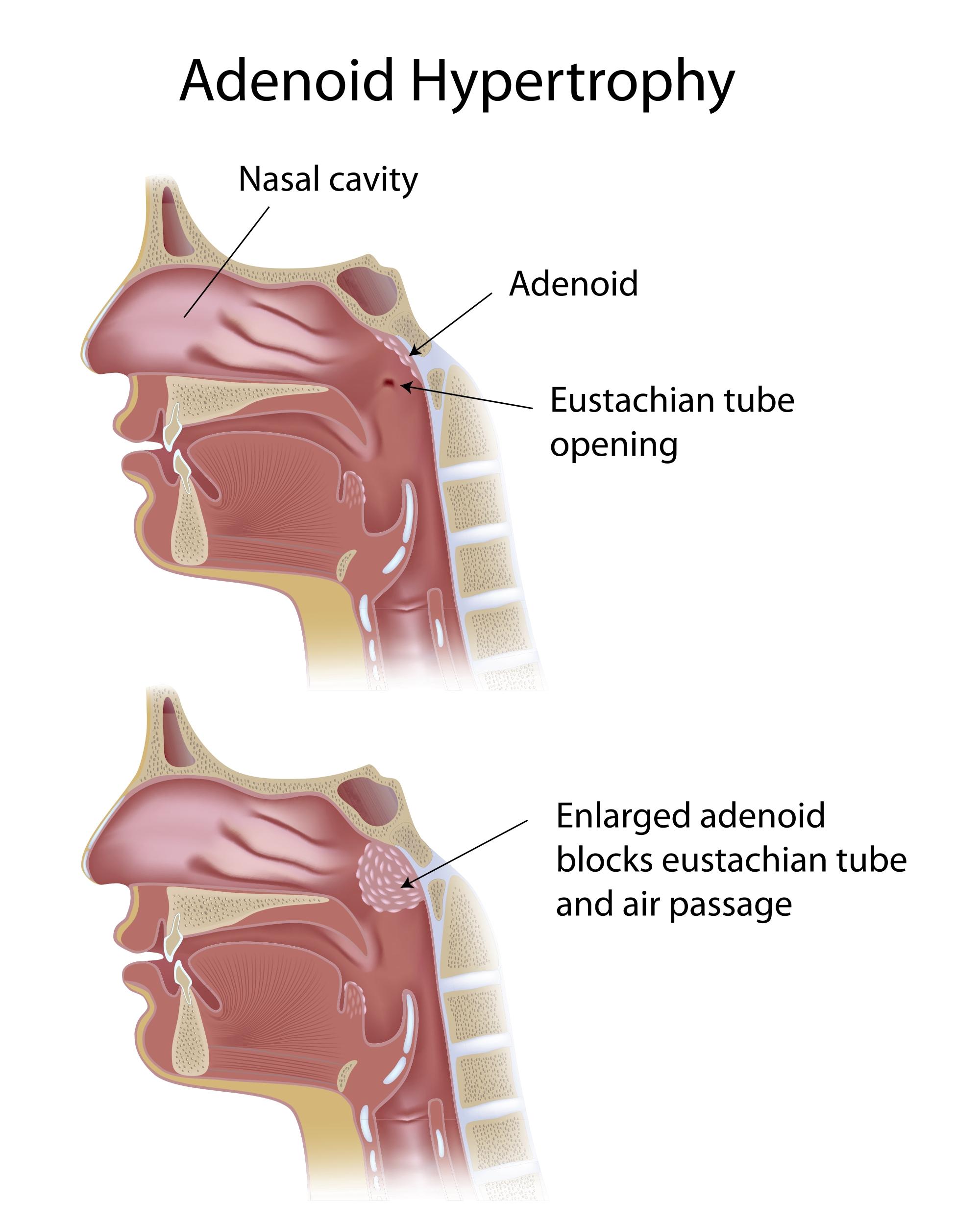 Adenoid