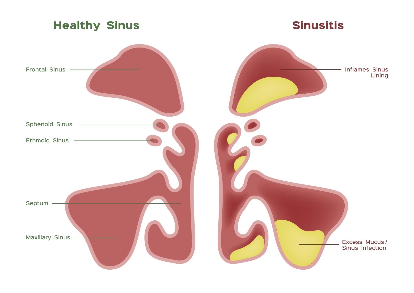 Sinusitis diagram