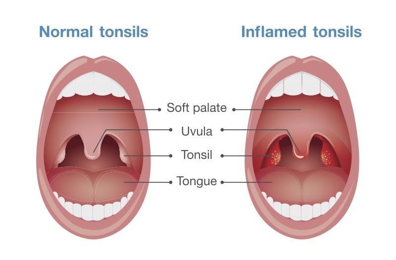 Tonsils